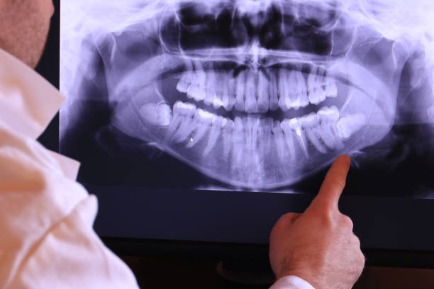 Best Emergency Root Canal Treatment in Lexington Park, MD